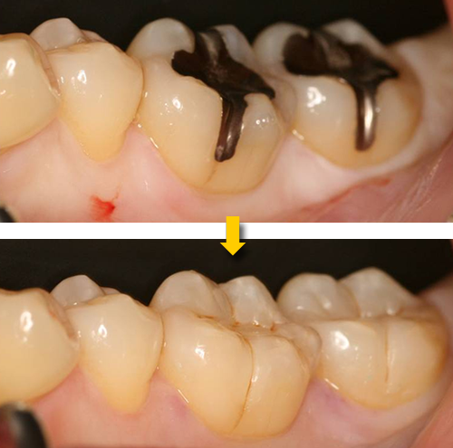 見える部分の銀歯の交換
