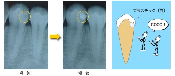 青く染まった虫歯部分を選択的にエキスカ(スプーン)で除去して行きます。