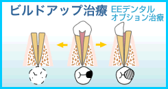 ビルドアップ治療