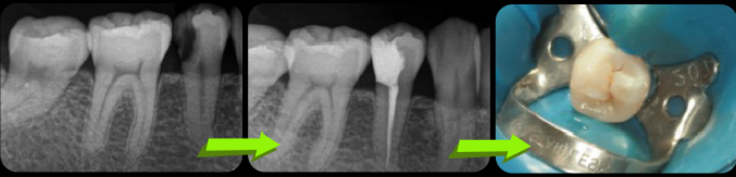 大きな虫歯による神経の治療とビルドアップ治療