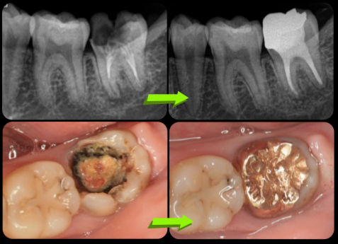 長期間放置した虫歯の治療