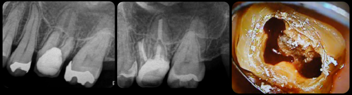 1年根管治療しているが治らないという歯