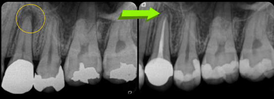 根管治療中に腫れてきた歯の保存