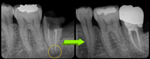 保存不可能といわれた歯の保存治療