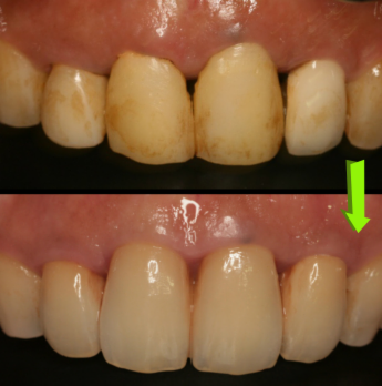 矯正後のグラグラ揺れた前歯の治療（連結セラミック）