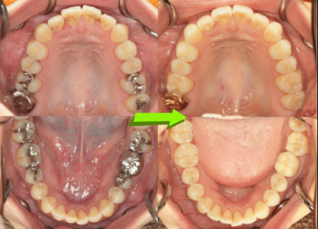 治しても治しても年々悪くなる歯
