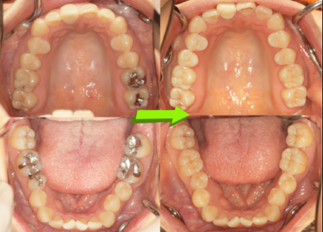 笑うと気になる銀歯を白く治したい