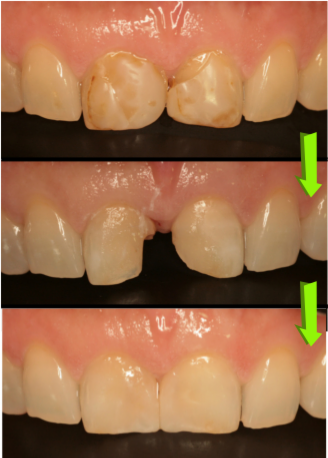 気になる前歯の再治療