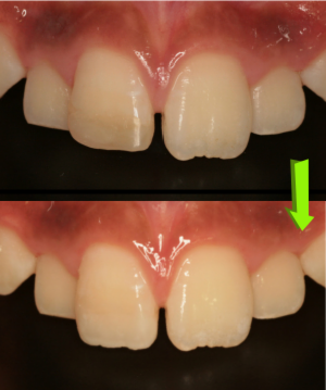 折れた前歯を自然な感じに治したい