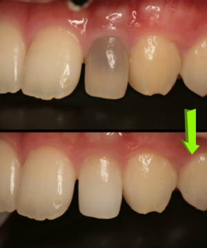 変色した前歯のホワイトニング+レジン治療