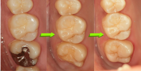 奥歯のレジン治療