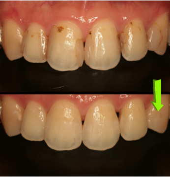 変色したレジン治療のやり代え