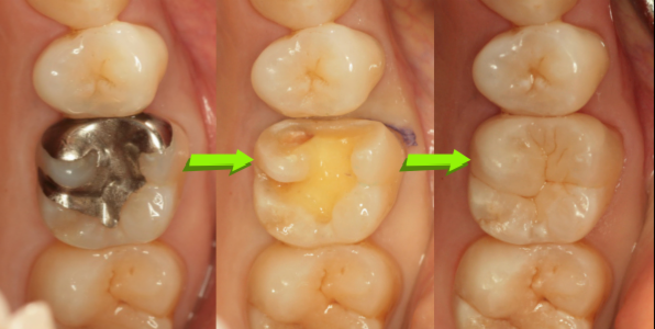 大きく削ってしまった銀歯のやり代え