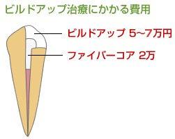 ビルドアップ治療にかかる費用