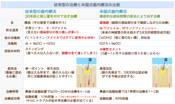 歯内療法　従来型の治療と米国式歯内療法の比較