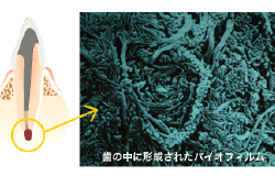 歯内療法　歯の中に形成されたバイオフィルム