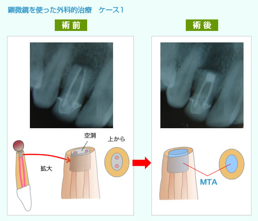 顕微鏡を使った外科的治療