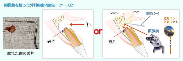 顕微鏡を使った外科的歯内療法