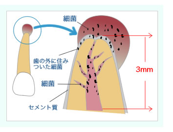 膿の包が出来る原因は歯の中の細菌であり、原因を処理しない限り何度でも再発します。