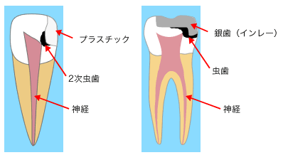 詰め物がしてある歯は要注意です。