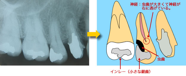 レントゲンで大きな虫歯を確認