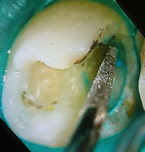 青く染まった虫歯部分を選択的にエキスカ(スプーン)で除去して行きます。