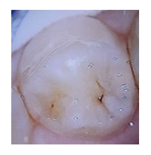 ここからは顕微鏡を見ながらエキスカ(スプーン)を用いて手作業で虫歯を除去します。