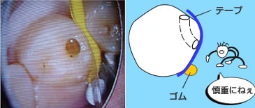 青く染まった虫歯部分を選択的にエキスカ(スプーン)で除去して行きます。
