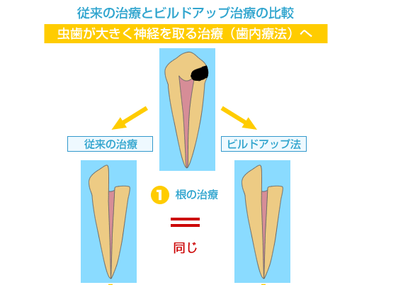 従来の治療とビルドアップ治療の比較