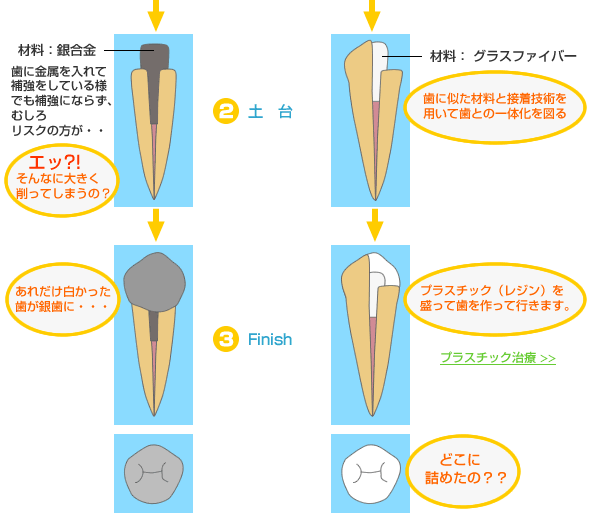 銀合金の場合、歯に金属を入れて補強しているようでも補強にならず、むしろリスクの方が大きいのです。