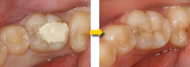 EEデンタルでのビルドアップ治療症例