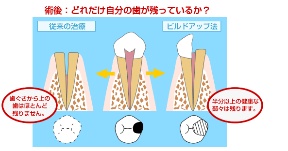 術後、どれだけ自分の歯が残っているか？